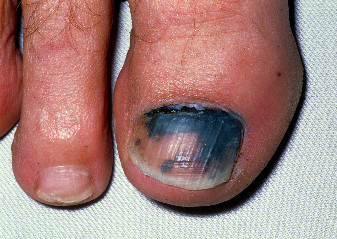 View of a subungual haematoma under a toenail