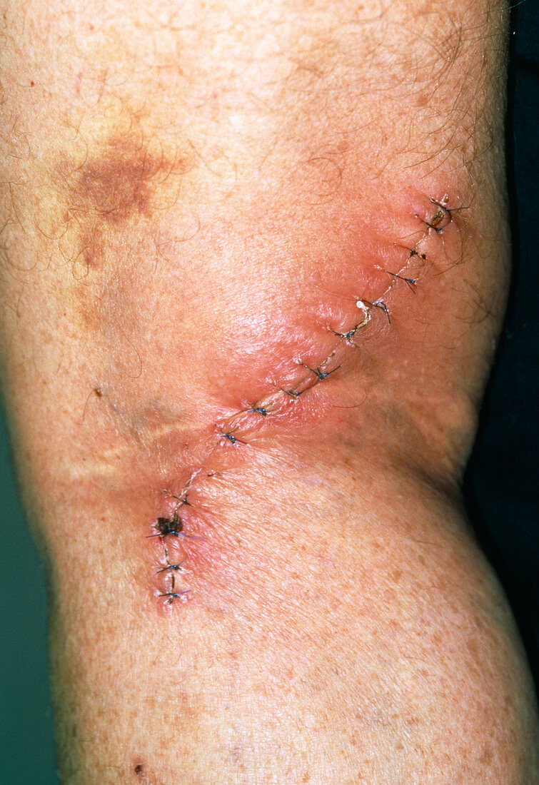 Infected sutures following baker's cyst excision
