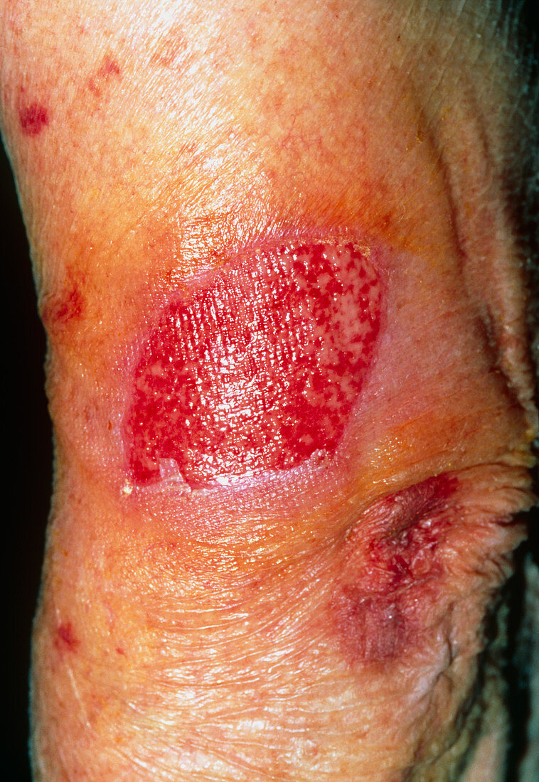 Skin loss on an elderly woman's arm after a trauma