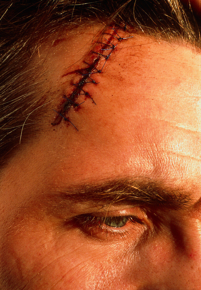 View of a sutured laceration on a man's scalp