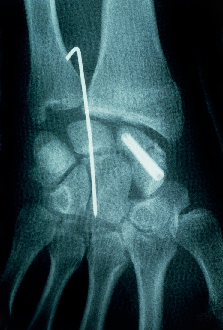 X-ray of a pinned wrist fracture