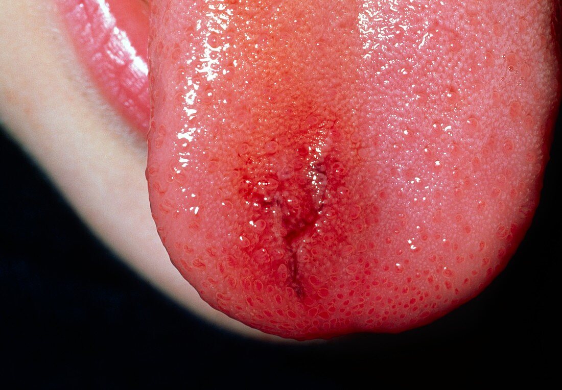 Bitten tongue
