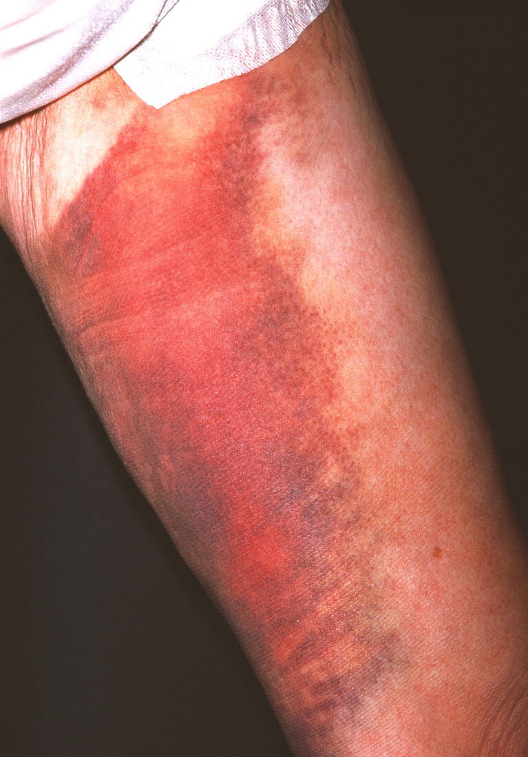 Post-operative bruising