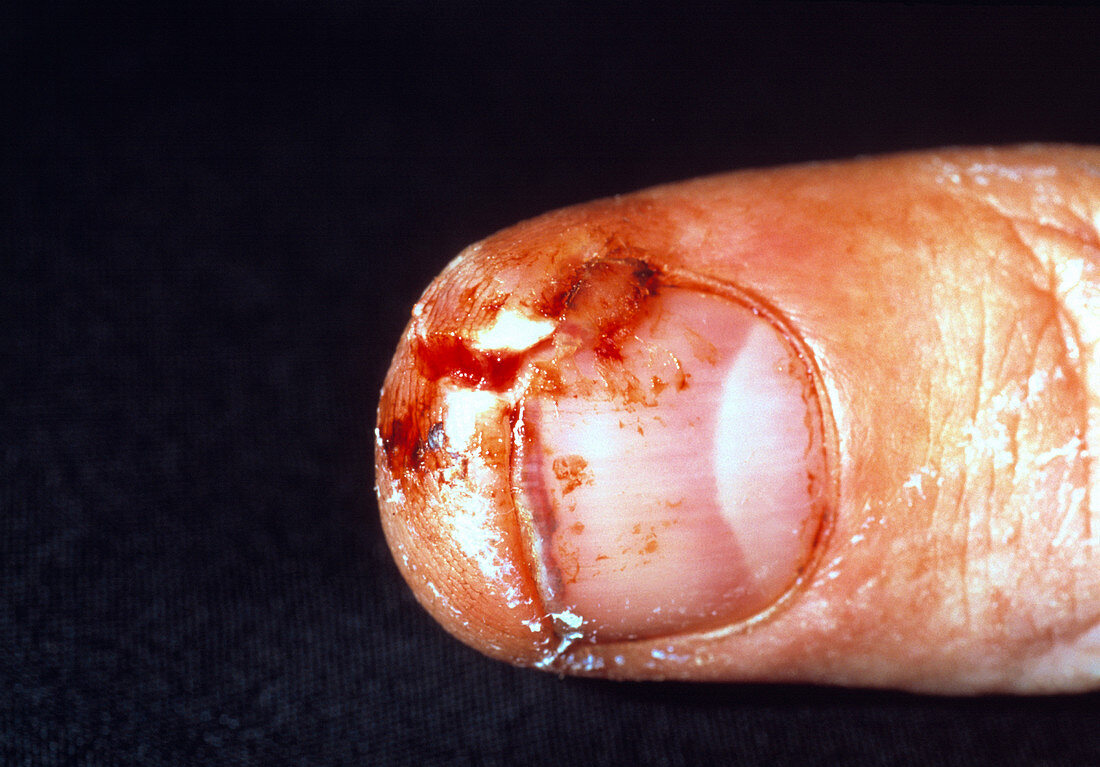 Lacerated finger