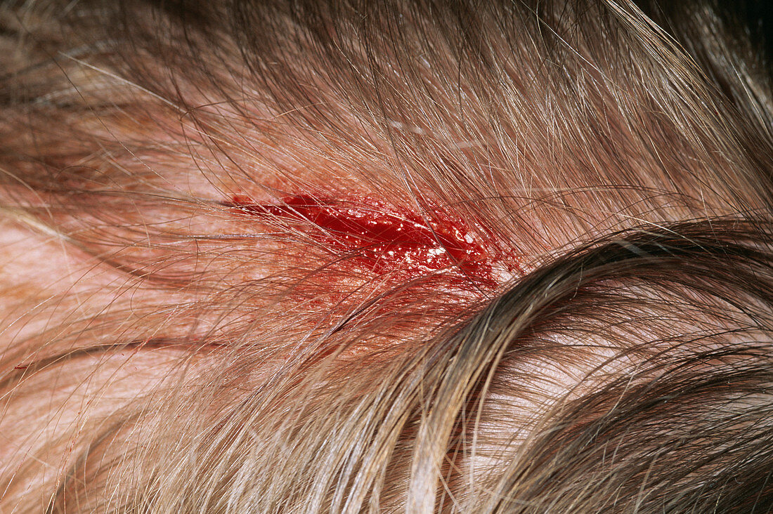 Cut scalp