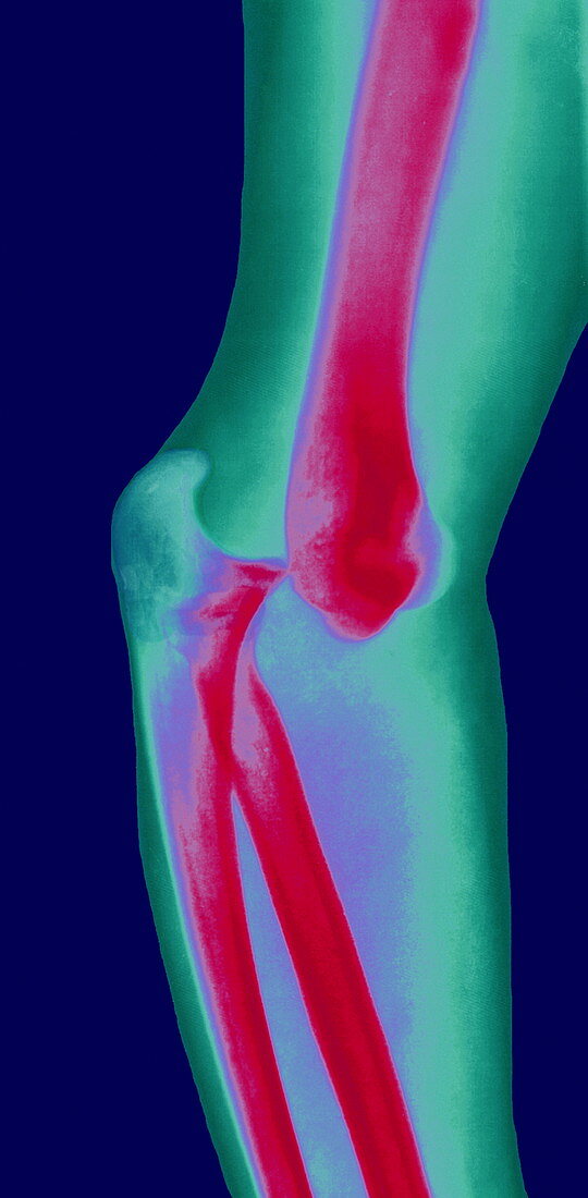 Dislocated elbow joint,X-ray