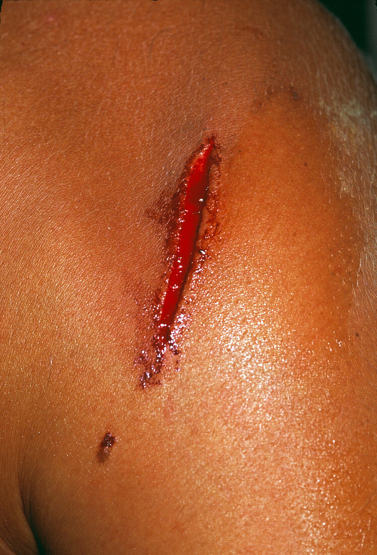 Cut on shoulder