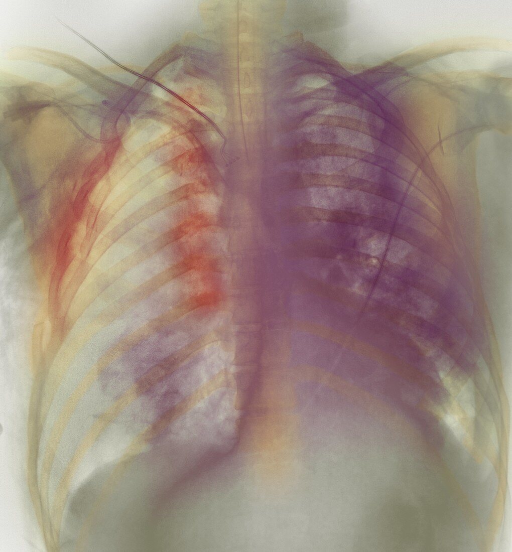 Rib fracture,X-ray