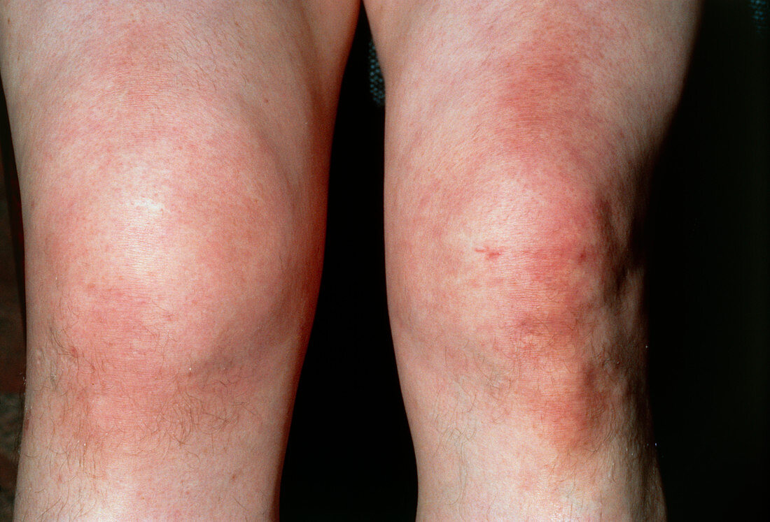 Close up: effusion of right knee,sports injury