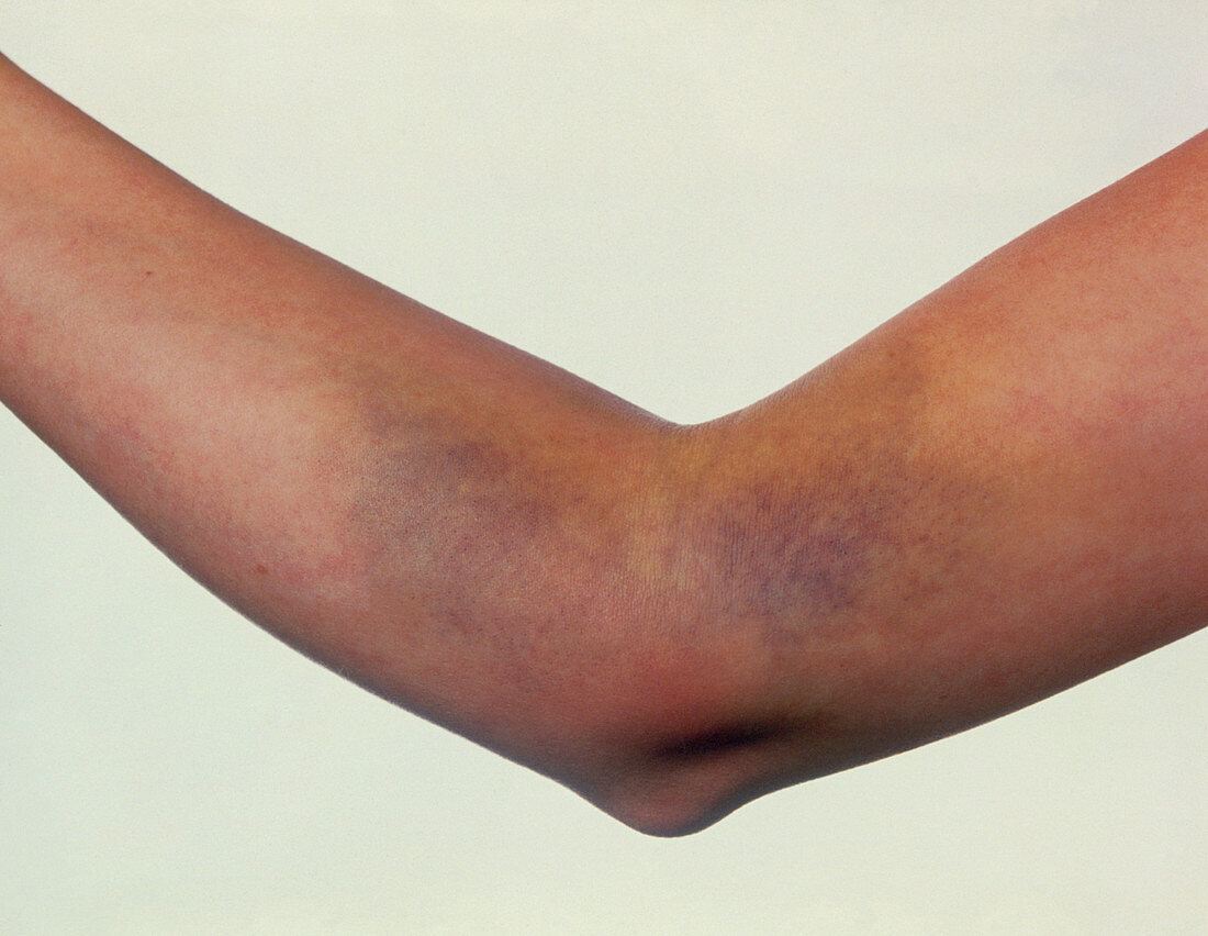 Bruising on woman's arm after blood test