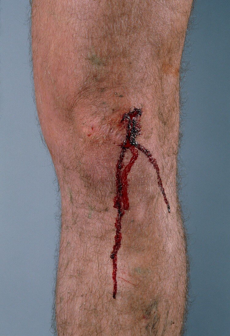 Cut on man's knee with blood flowing down the leg