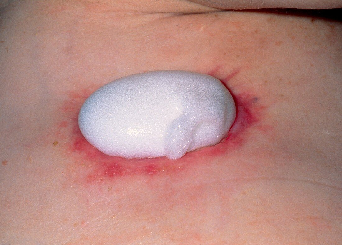 Foam plug dressing in chronically infected wound