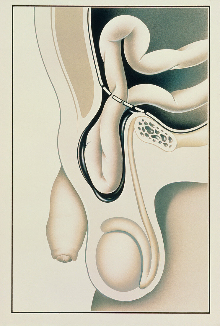 Artwork showing scrotum with inguinal hernia