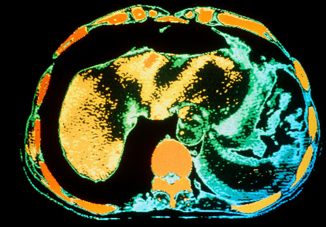 Coloured computed tomography scan of burst spleen