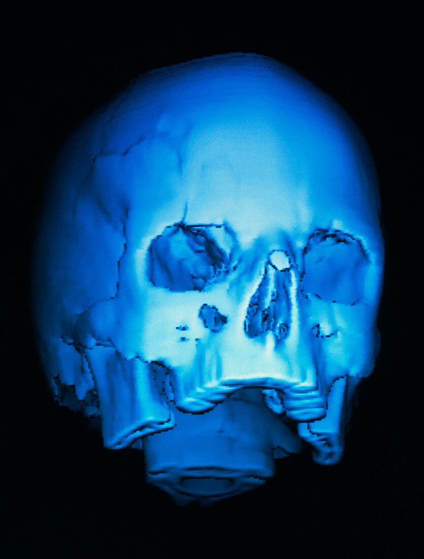 3-D CT scan of skull,with fracture above eye