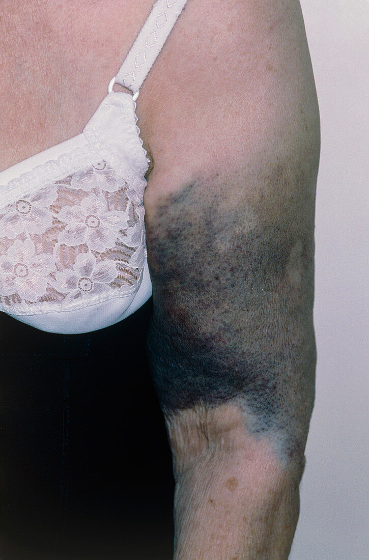 Bruising on a woman's arm due to fractured humerus