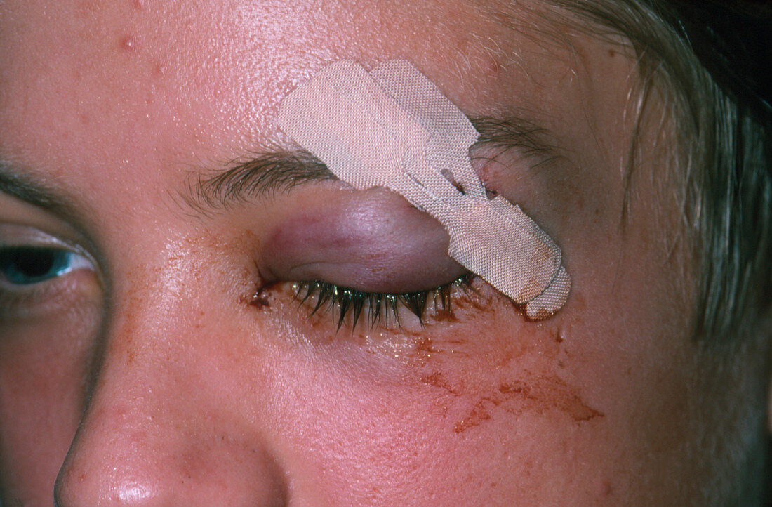 Hockey stick injury to eye