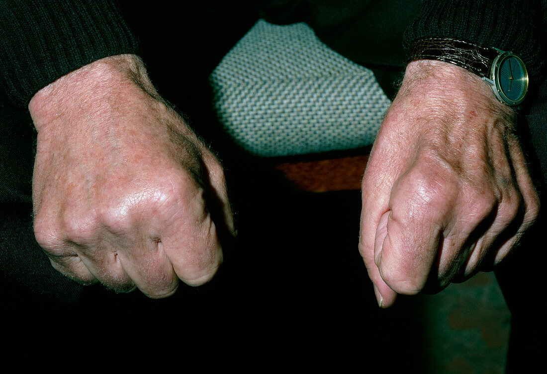 Muscle wasting in hand due to ulnar nerve damage