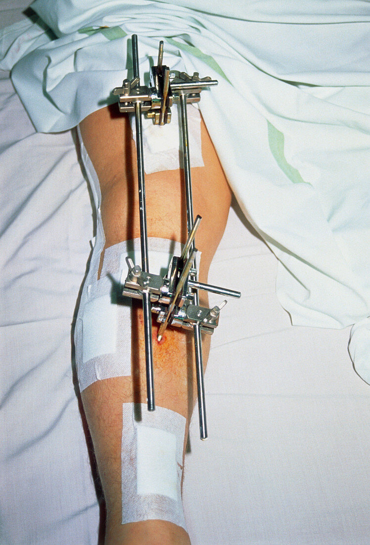 Metal frame attached to a patient's broken leg