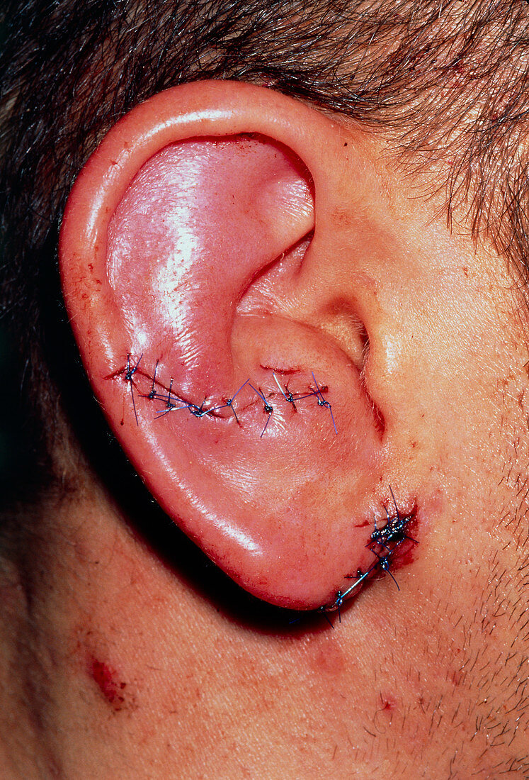 Sutured haematoma (cauliflower) ear in young man