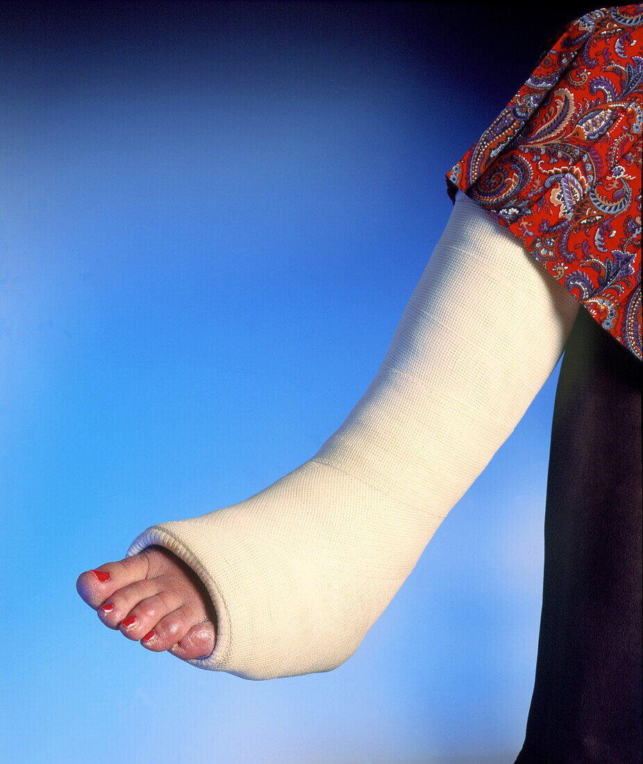 Plaster cast on the broken leg of a woman