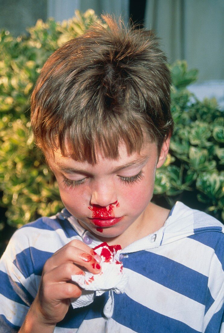 Boy,aged six,with nosebleed