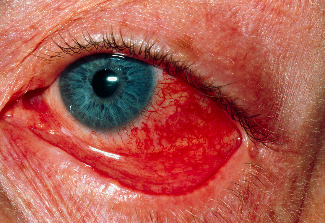 Tennis ball injury to eye
