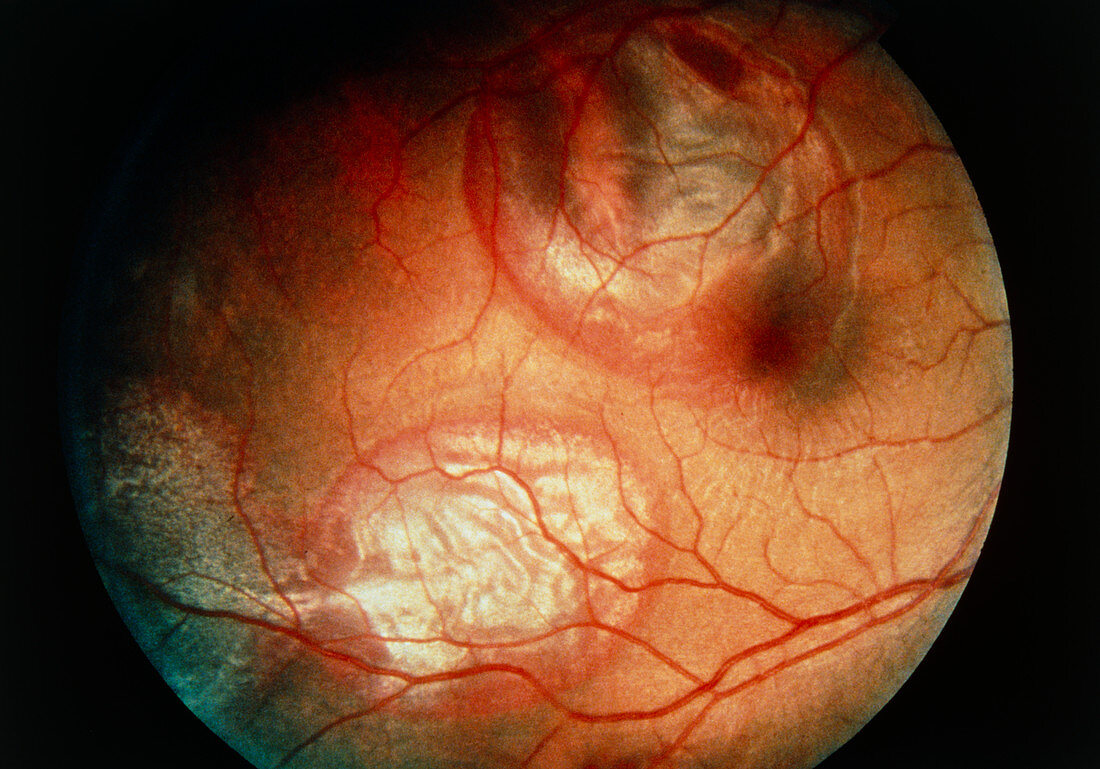 Ophthalmoscope view of cricket ball eye injury