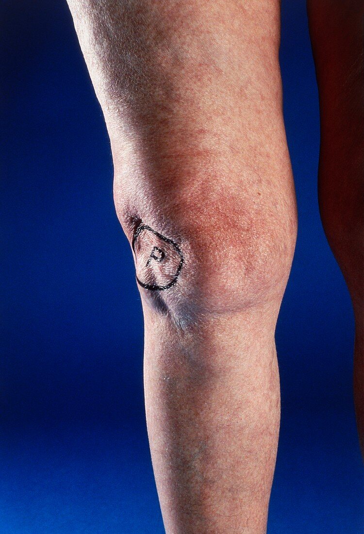 Dislocated kneecap in elderly patient's leg