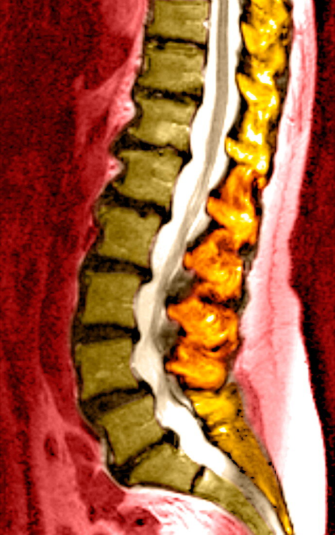 Spine degeneration,MRI scan