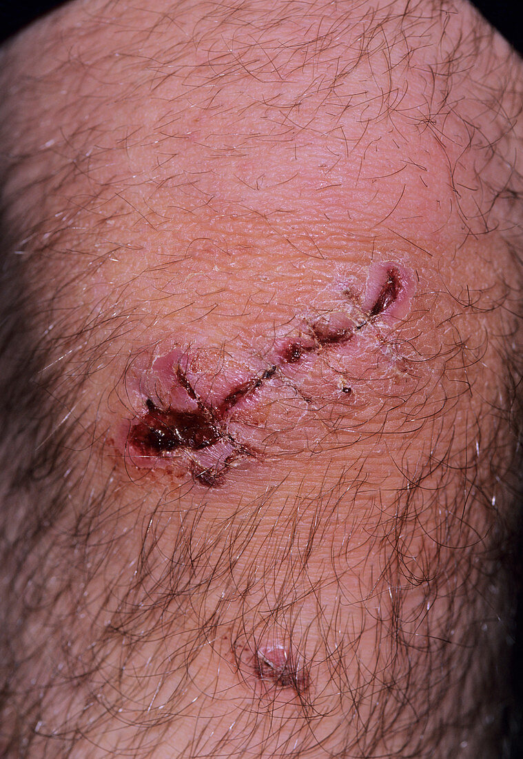 Knee wound