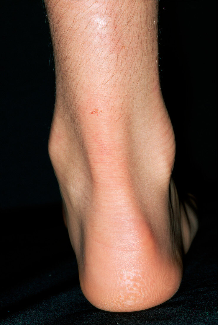 Swollen achilles tendon