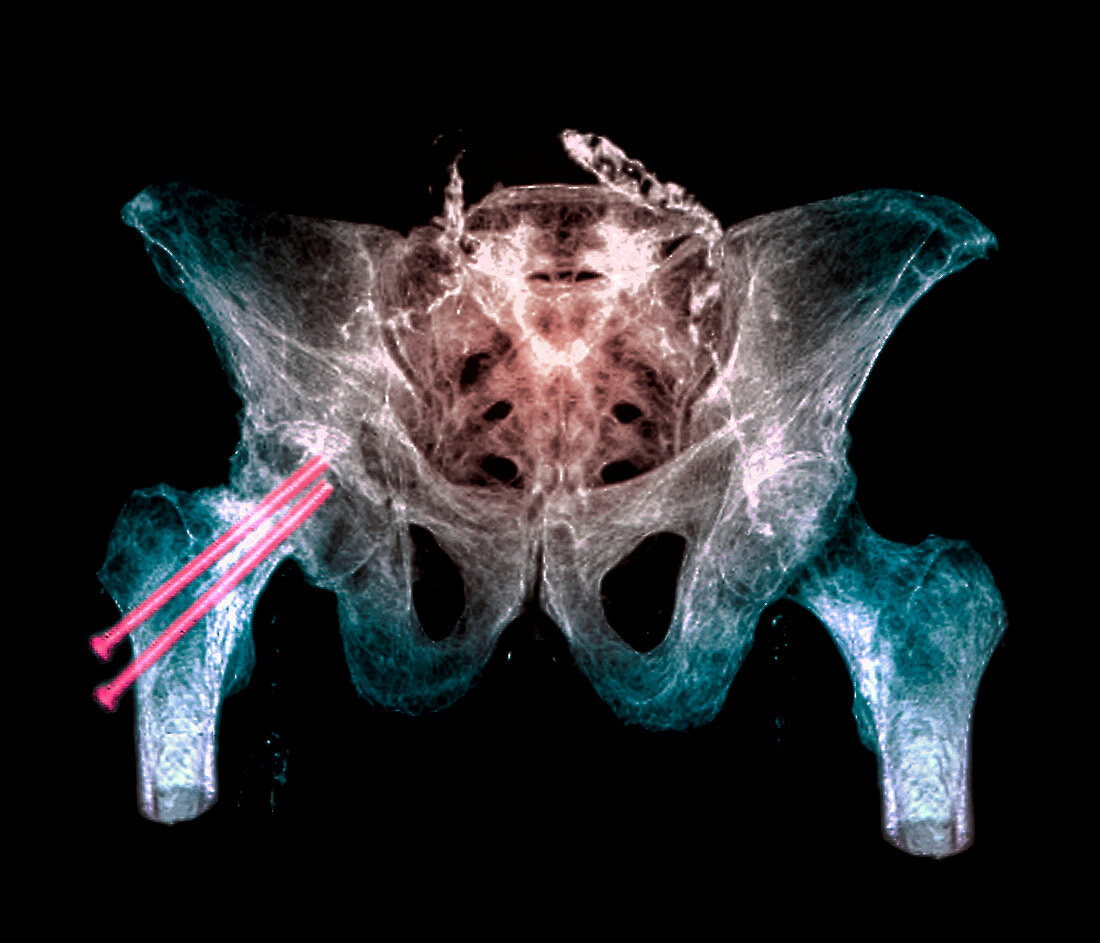 Pinned broken hip,X-ray