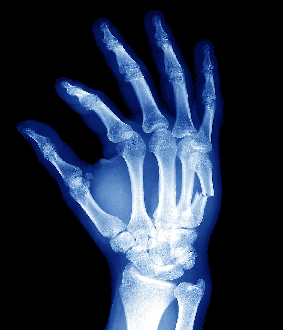 Broken hand bone,X-ray