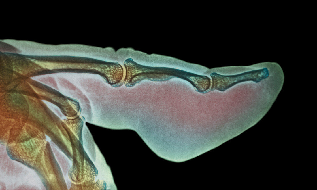 Finger inflammation,X-ray