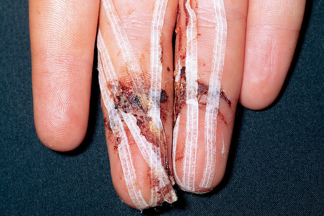 Cut fingers