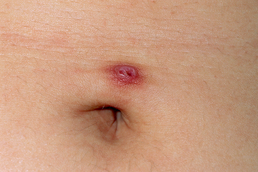 Infected piercing site