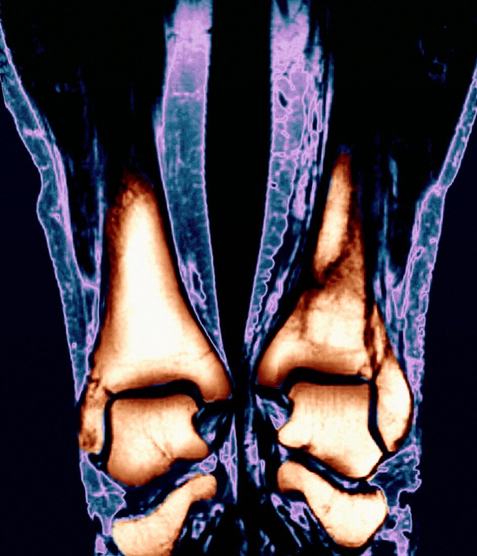 Broken ankle,MRI scan