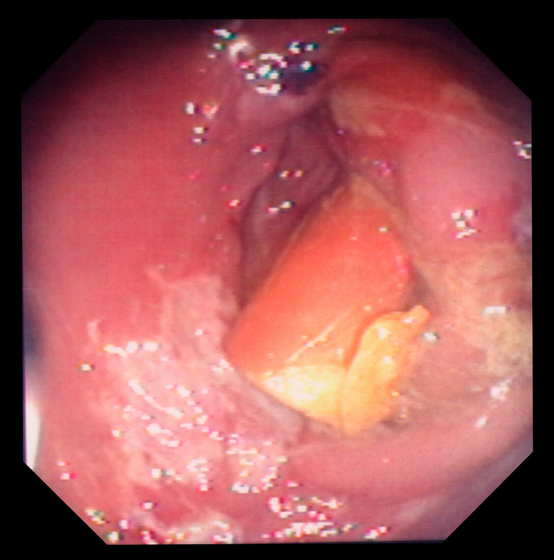 Rectal inflammation