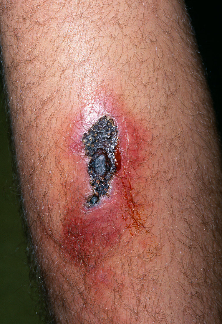 Infected leg wound