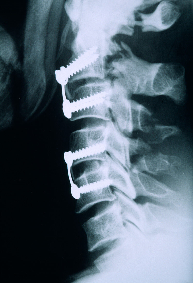 Broken neck after pinning,X-ray