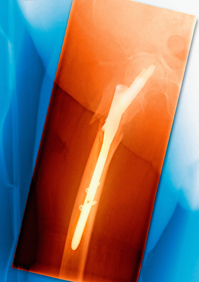 Pinned broken leg,coloured X-ray