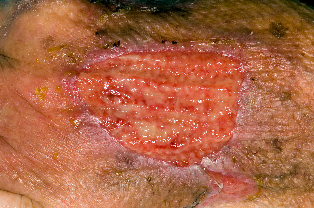 Infected hand wound
