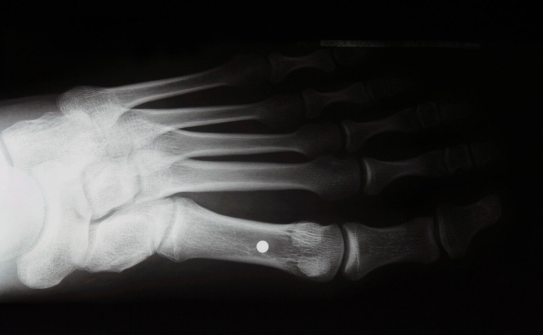 Shotgun pellet in foot,X-ray