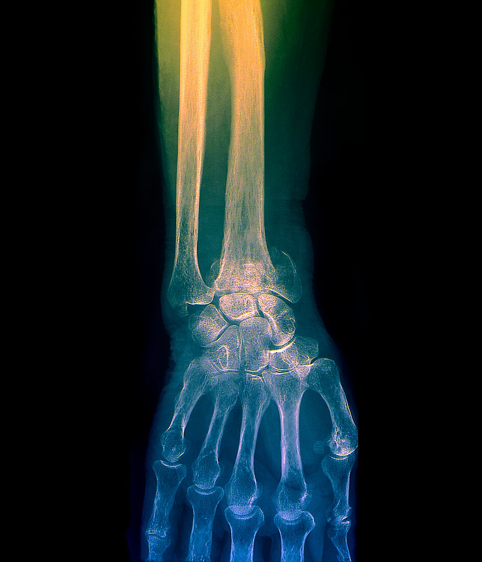 Colles' wrist fracture,X-ray