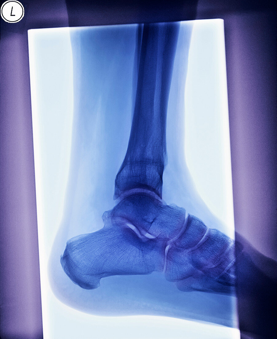 Deformed ankle after fracture