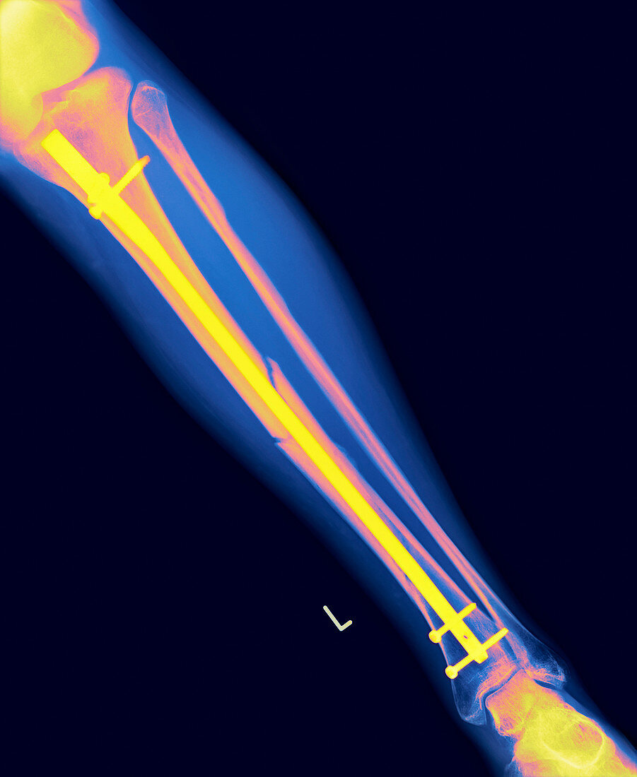 Pinned leg fracture,X-ray