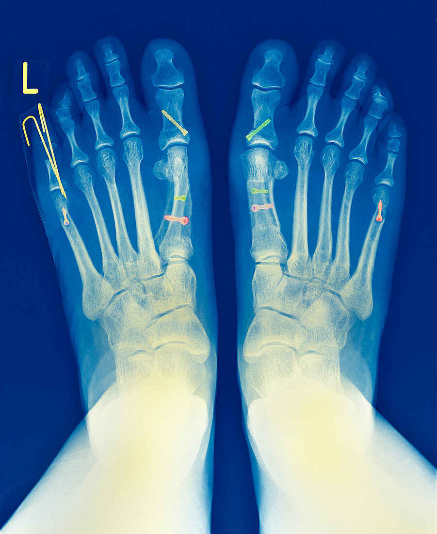 Pinned feet,X-ray