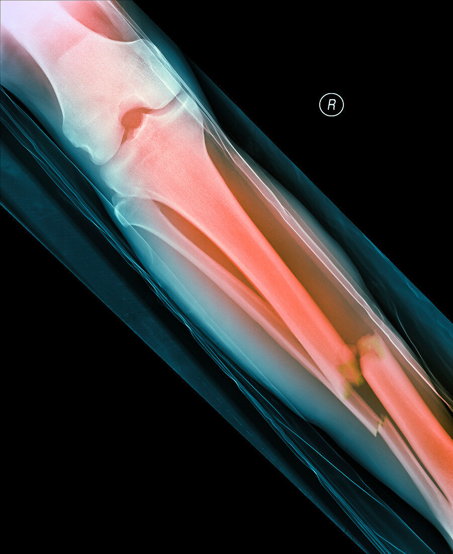 Fractured leg bones,X-ray