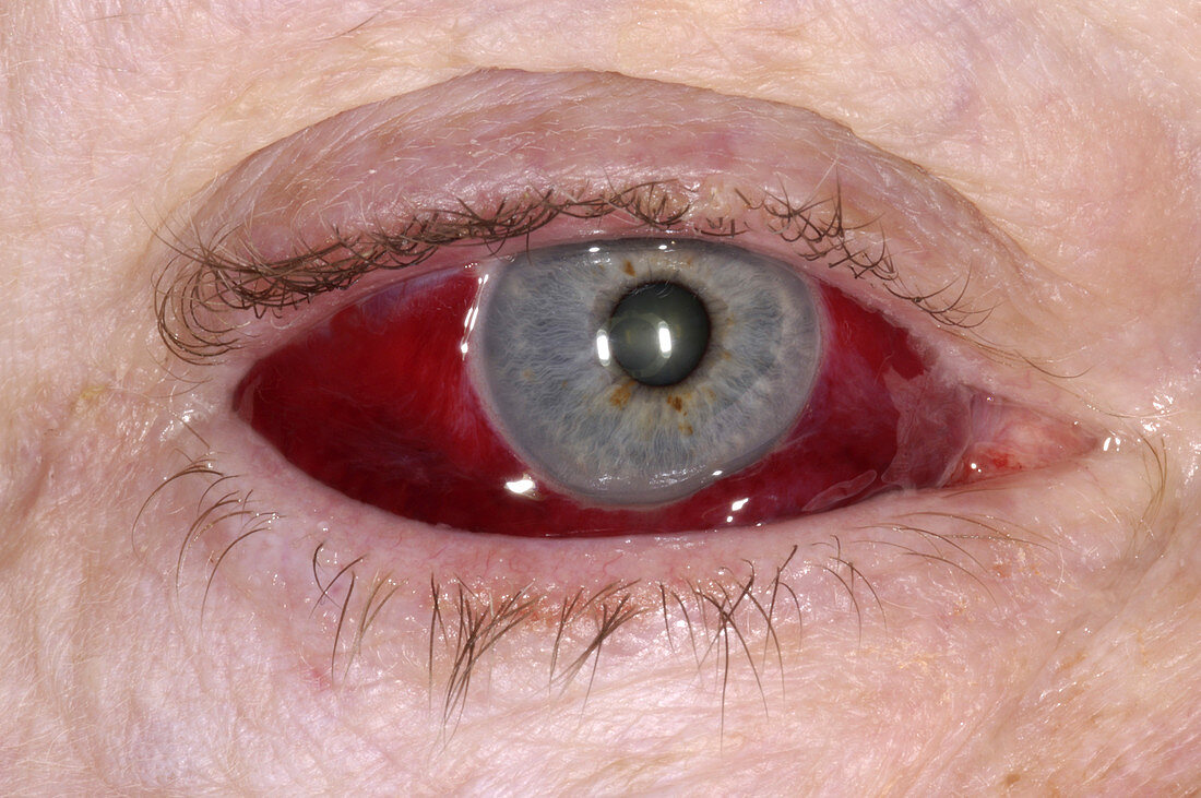Sub-conjunctival bleeding due to fracture